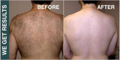 Chest, neck, back & eyebrow laser hair removal for men | Glamour Laser